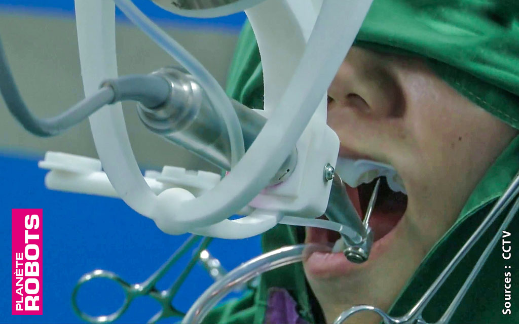 Pour la première fois un robot joue au dentiste sur un vrai patient