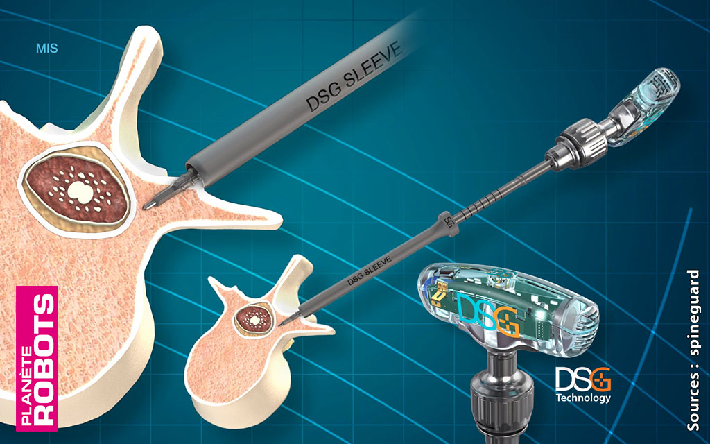 La technologie DSG pour une chirurgie toujours plus précise